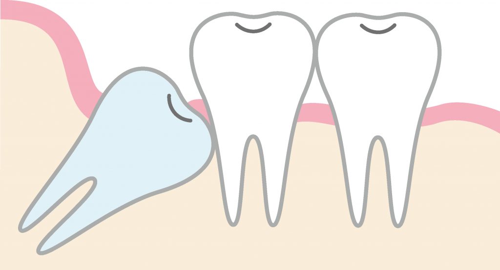 親知らずの正しい磨き方とは？状況別の磨き方とチェック方法について